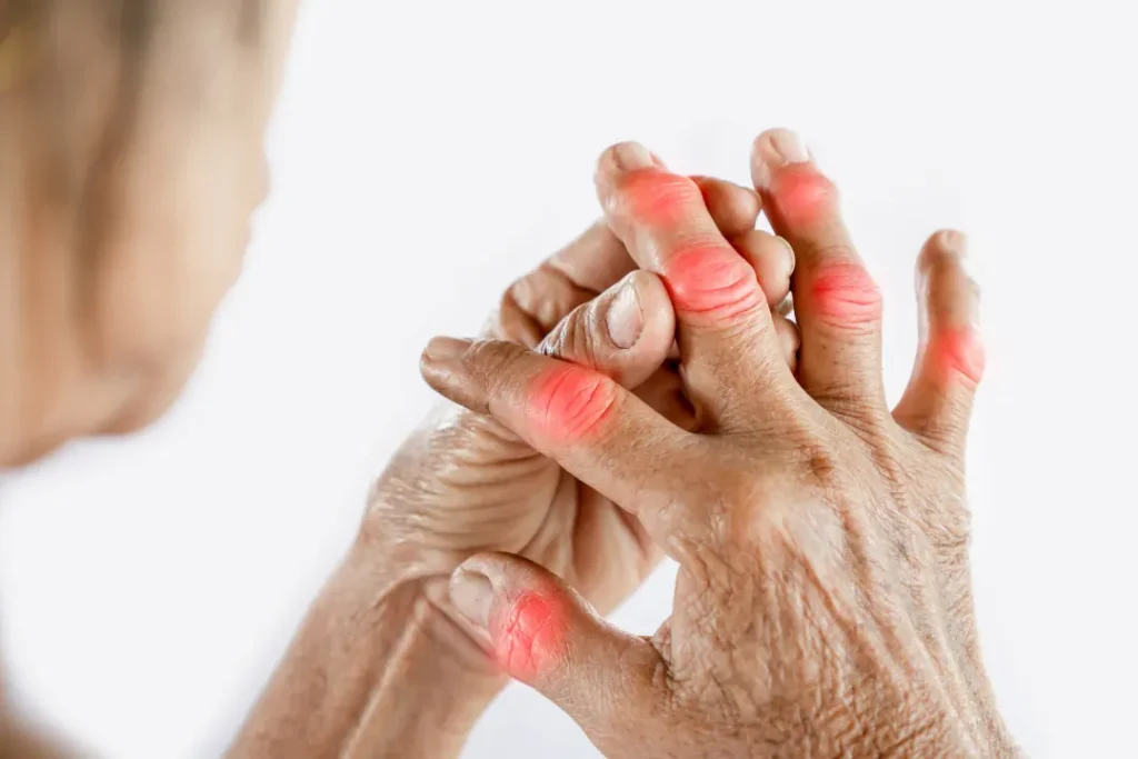 Woman suffering from finger pains due to high uric acid. 